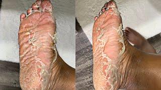 I TRIED A CRAZY FOOT PEEL MASK *INSANE RESULTS* 