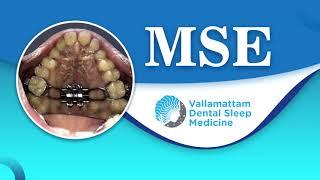 Maxillary Skeletal Expander (MSE) in Dental Sleep Medicine Dr. Jojo Joseph, Vallamattam Dental Sleep