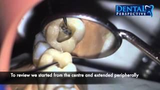 Lower First Molar - Access  Cavity / Endo HD - Dental Perspective