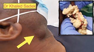 Double Trouble Jaw Cyst. Dr Khaled Sadek