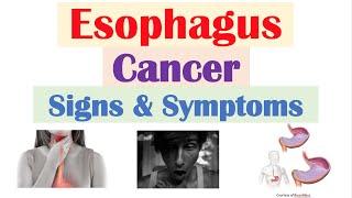 Esophageal Cancer Signs & Symptoms (& Why They Occur)