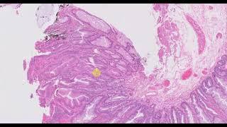 Sessile serrated adenoma with dysplasia