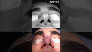 Breathtaking Transformations: Dr. Bashar Bizrah's Rhinoplasty Before & After