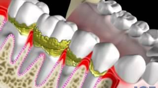 Periodontist Dr McCawley shares Gum Disease in Fort Lauderdale, FL