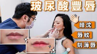 刻薄唇️歐美唇｜玻尿酸豐唇初體驗｜我也有微笑唇啦｜緹神醒腦 ft. @skindrtw_beauty