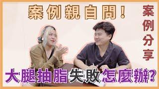 【大腿抽脂｜真實見證】抽脂失敗怎麼辦？網紅親自幫你問整形外科醫師！｜整形外科蘇瑋智醫師 ft. 石見三也@kuma_yanchi