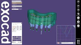 exocad Video Tutorial: Model Creator