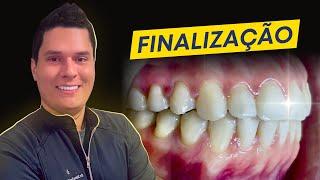 Finalização Ortodôntica : 5 coisas que ATRAPALHAM a boa finalização dos seus casos!