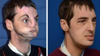 The Powerful Outcome of Face Transplant