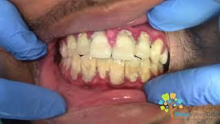 Dental Cleaning to remove heavy tartar.  【Young Male first cleaning】