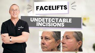 Undetectable Facelift: The Secret to Looking 10 Years Younger Without Anyone Knowing