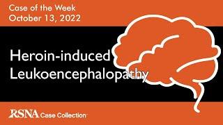 Case of the Week: Heroin-induced Leukoencephalopathy