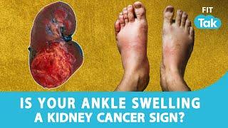 Could swelling of ankles and legs be an early sign of Kidney Cancer? | DOC TALK | FIT TAK