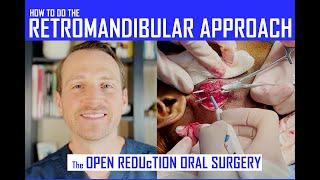 HOW TO DO the RETROMANDIBULAR APPROACH & DISSECTION