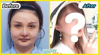  Fantastic Before and After photos from NANA Korea Plastic Surgery | Makeover transformation 