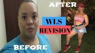 Do you need a WLS Revision? #vsg #vsgsurgery #vsgjourney #vsgpostop #vsgcommunity