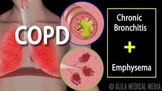 COPD - Chronic Obstructive Pulmonary Disease, Animation.