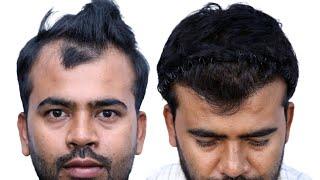 Discovering Excellence at New Roots, the Best Hair Transplant Clinic in Bangladesh