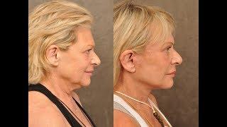 Best Facelift plastic surgery by top Beverly Hills facial surgeon Dr. Ben Talei