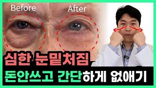 눈밑 처짐. 눈 밑이 불룩해지는 진짜 이유. 돈안쓰고 집에서 좋아지는 방법.