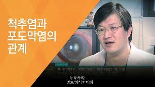 척추염과 포도막염의 관계 - (20130309_451회 방송)_젊은 허리를 노린다, 강직성 척추염