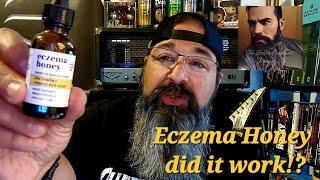 Eczema Honey final review, Did it work?!