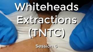 Whiteheads Extraction (TNTC) - Session 6