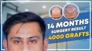 Hair Transplant in Hyderabad | Best Results & Cost of Hair Transplant in Hyderabad