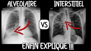 Médecine | Tout savoir sur la radiographie de thorax