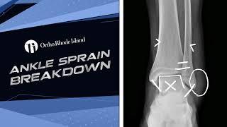 Ankle Sprain Breakdown