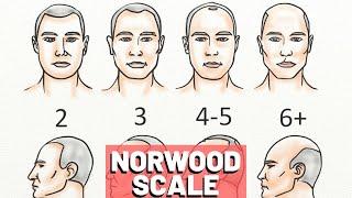 Norwood Scale Explained - With 7 REAL Examples