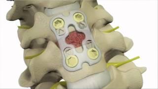 Anterior Cervical Discectomy and Fusion - DePuy Videos