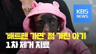 [클릭@지구촌] ‘배트맨 가면’ 무늬 점 가진 아기…“1차 치료 성공적” / KBS뉴스(News)