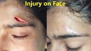 Face injury treatment | Plastic surgery of facial injury | face injury treatment in Ranchi #face