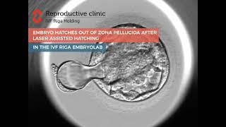 iVF Riga - An embryo hatches out of zona pellucida after Laser Assisted Hatching