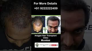 5 Months Hair Transplant Result // Mumbai // #hairtransplant #mumbaihairtransplant