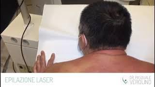 Epilazione definitiva con laser Thunder Mt