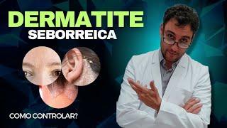 Como controlar a Dermatite Seborreica?