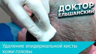 Удаление эпидермальной кисты (атеромы) головы. Removal of atheroma (cyst) of the scalp
