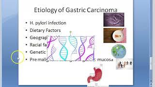 Pathology 521 c Etiology Gastric Carcinoma Stomach Cancer Causes Blood Group A polyps