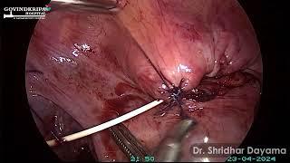 Laparoscopic repair of the injured bladder (VVF)