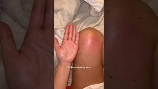 SPIDER BITE REACTION #spider #spiderbite #sensitiveskin #bugbite #reaction