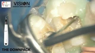 Warm Vertical Compaction in Mandibular Molar with GuttaSmart IQ Unit