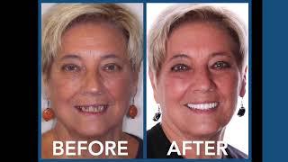 All on 4 and Dental Implants in Charlotte North Carolina