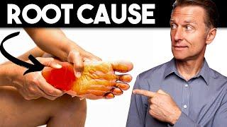 Peripheral NEUROPATHY (Root Cause and Best Remedy) — Dr. Berg