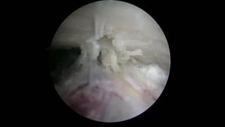 Arthroscopic Acromioclavicular Joint Reconstruction