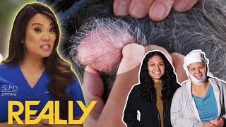 Dr Lee Helps Woman With 'Second Head' Pilar Cysts Gain Back Control Of Her Life | Dr Pimple Popper