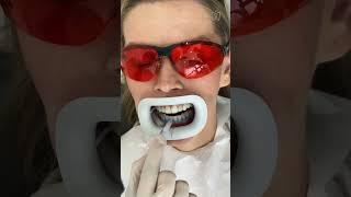 Teeth Whitening Process #shorts
