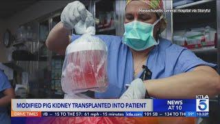 US surgeons transplant a gene-edited pig kidney into a patient for the first time