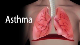 Asthma, Animation.